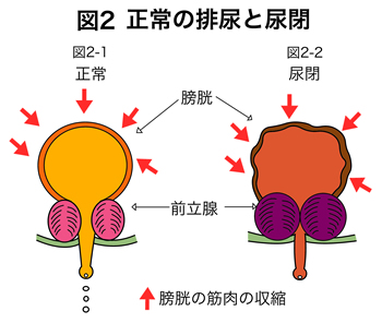 尿 が 出 そう で 出 ない