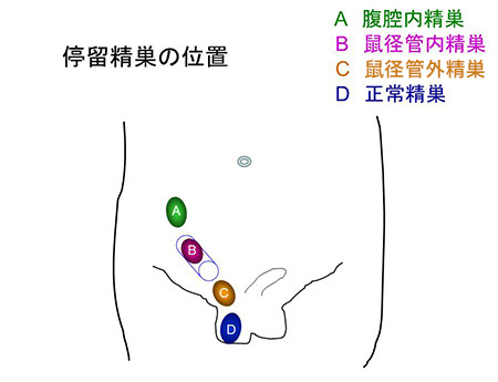 子供の精巣が降りていない と言われた 日本泌尿器科学会 The Japanese Urological Association 一般のみなさま