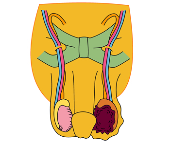 睾丸 精巣 が腫れてきた 陰嚢 内容 が大きくなってきた 日本泌尿器科学会 The Japanese Urological Association 一般のみなさま