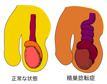 睾丸 精巣 が腫れてきた 陰嚢 内容 が大きくなってきた 日本泌尿器科学会 The Japanese Urological Association 一般のみなさま