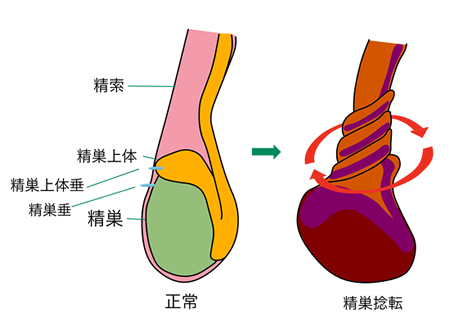 陰嚢内が痛い 日本泌尿器科学会 The Japanese Urological Association 一般のみなさま