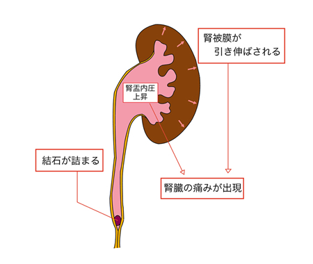 痛み 腎臓